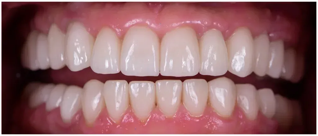 After — Before and after: porcelain veneers